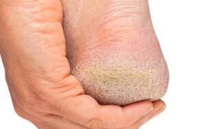 Hånd som holder en fot med tørr hud på hælen.