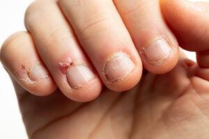 Neglebiter sine negler med skader på neglebåndene.