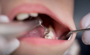 Åpne munn med tannlegeinstrumenter i.