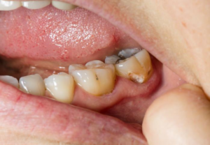 Nærbilde av hull i en tann rett ved tannkjøttet.