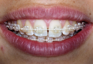 Nærbilde av tannregulering.