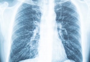 Røntgen-bilde av lunger.